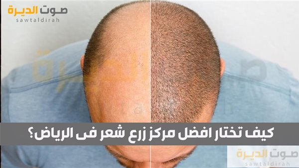 كيف تختار افضل مركز زرع شعر فى الرياض؟