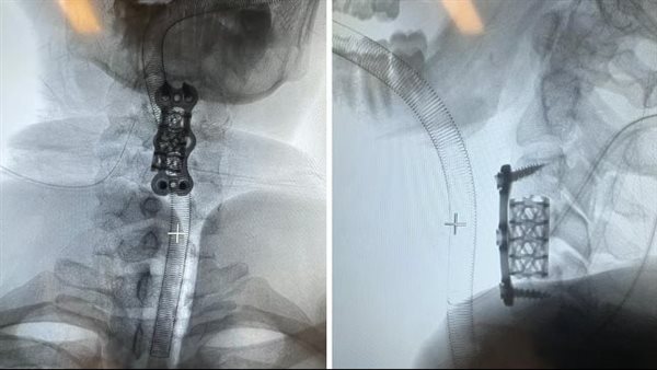 إنقاذ مريض بعد ثلاث عمليات دقيقة بمجمع الملك فيصل الطبي بالط